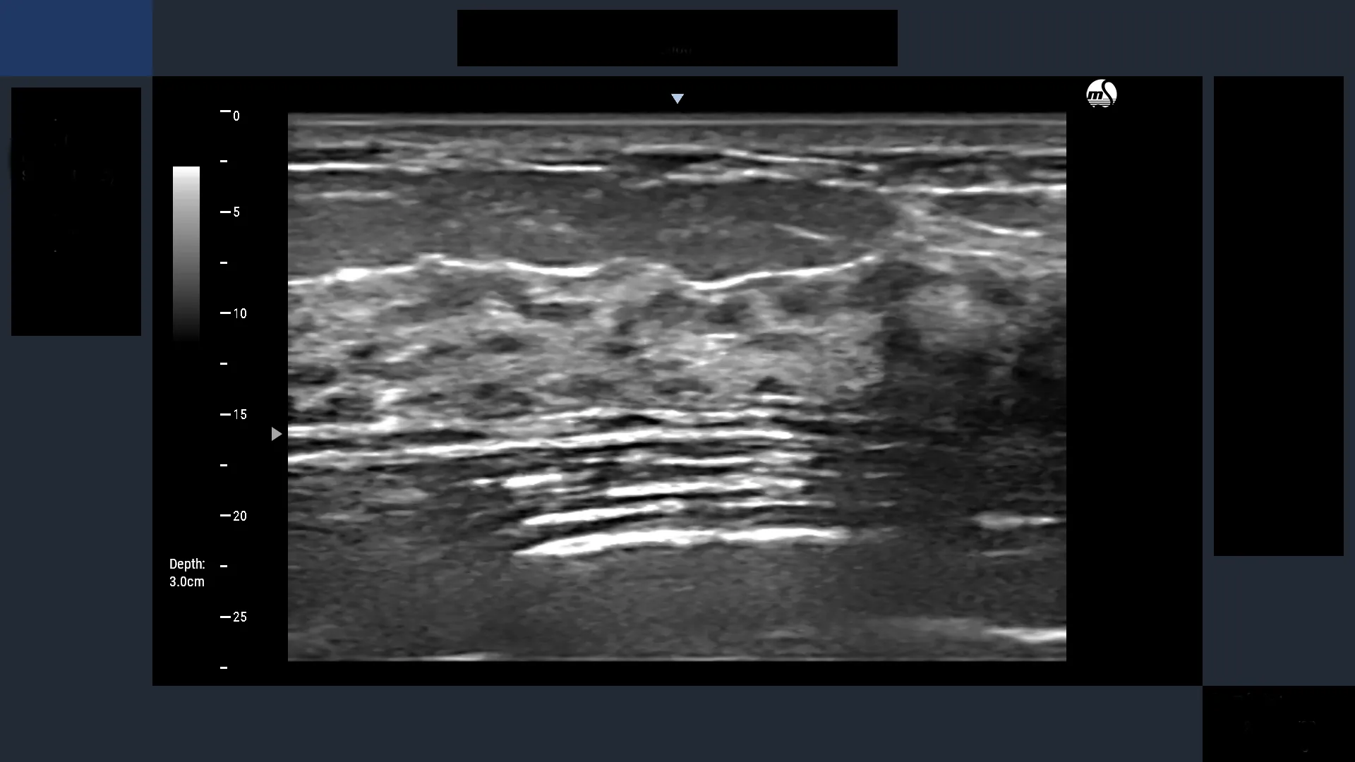 BreastScan 表示画面